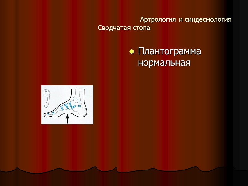 Артрология и синдесмология Сводчатая стопа Плантограмма нормальная